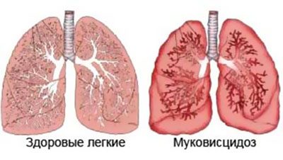 Симптомы и лечение коллапса лёгких
