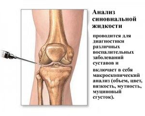 Восстановление суставной жидкости в коленном суставе: что делать при нехватке смазки