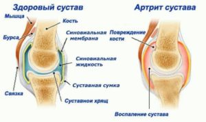 Причины болей под и над коленным суставом у подростка: методы лечения и профилактики