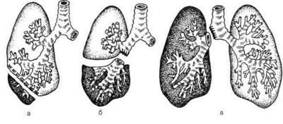 Гамартома лёгкого: причины, симптомы и лечение