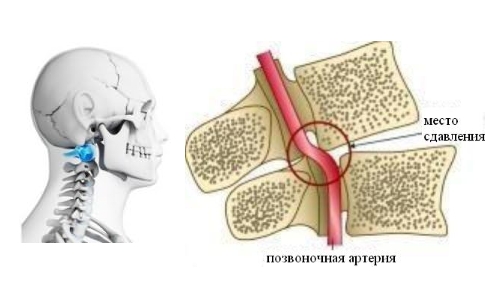 Как проявляется тремор головы при остеохондрозе шеи?