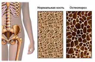 Хондроматоз и другие заболевания тазобедренного сустава