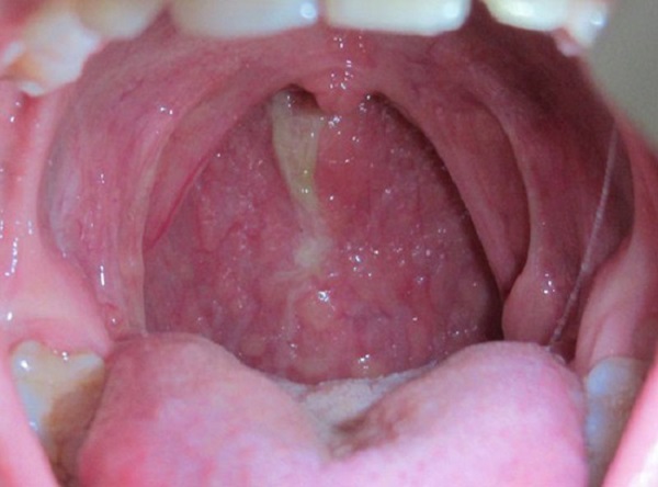 Воспаление и боли в задней стенке горла: причины, лечение и профилактика