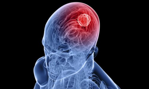 Насколько опасен энцефалит головного мозга?