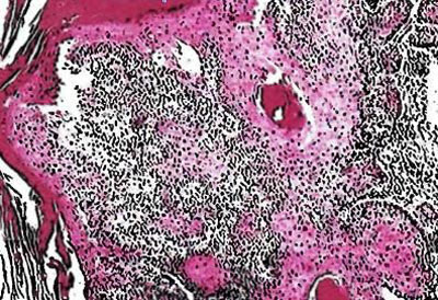 Симптомы и лечение плоскоклеточного рака гортани