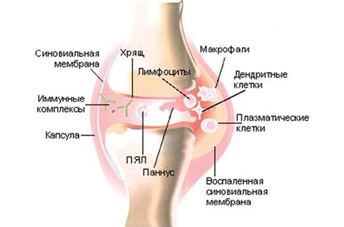 Рентгенологические стадии ревматоидного артрита