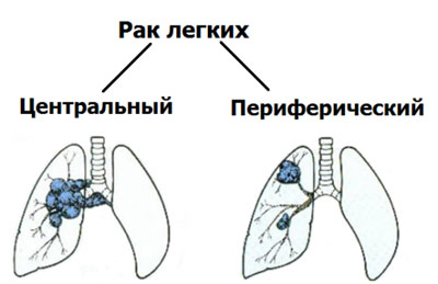 Преднизолон при астме и бронхите