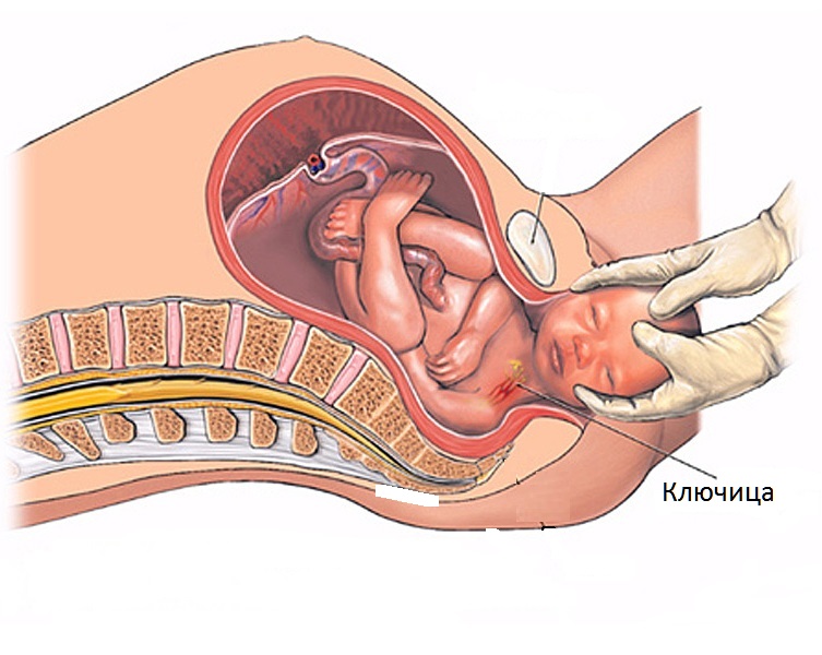 Как лечить перелом ключицы у новорожденного?