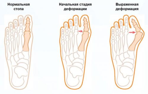 Косточка на ноге сбоку с внешней стороны стопы: причины и лечение