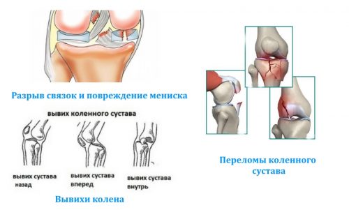 Причины и лечение болей в области колена при сидении