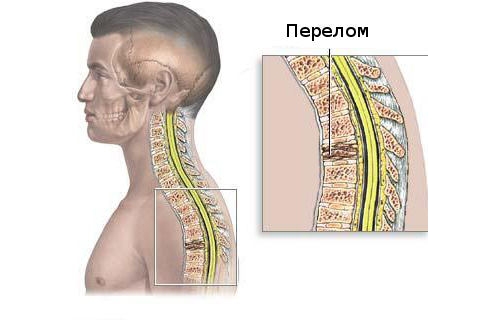 Лечение компрессионного перелома грудного позвонка