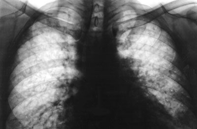 Симптомы, причины и эффективные методы устранения альвеолита лёгких