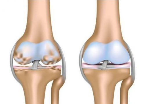 Лечение пиявками коленных суставов при артрозе и артрите