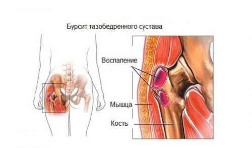 Симптомы и лечение бурсита тазобедренного сустава