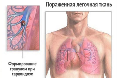 Симптомы и лечение аспергиллёза лёгких