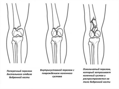 Виды переломов коленного сустава и методы лечения