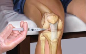 Лечение пателлофеморального артроза коленного сустава
