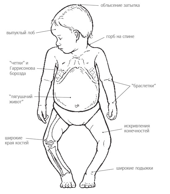 Лечение варусной деформации нижних конечностей у детей