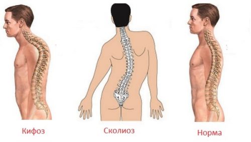 Причины боли в спине в области выше поясницы и ее лечение