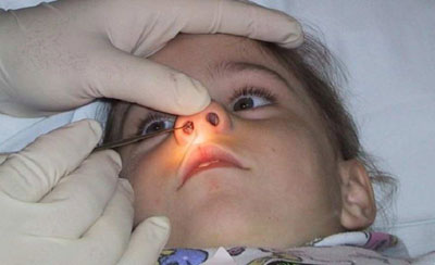 Симптомы и лечение полипов в носу у ребёнка