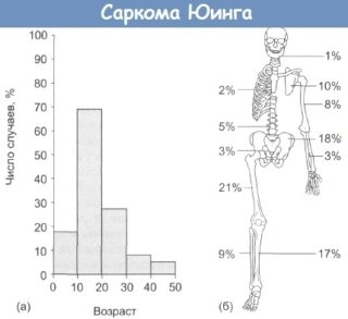 Опухоль бедренной кости: проведение прокола и характеристика пунктатов
