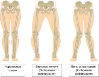 Вальгусная деформация шеек бедренных костей: постановка диагноза, лечение, реабилитация и профилактика
