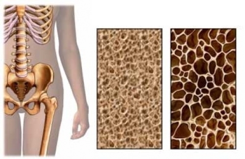 Чем отличается болезнь остеопороз от остеопении?