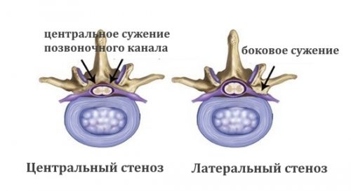 Симптомы стеноза шейного отдела позвоночника и его лечение