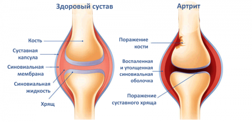 Народные методы лечения артрита коленного сустава