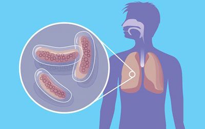 Туберкулёз и ВИЧ: тактика лечения, прогноз