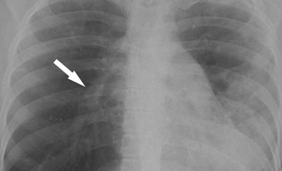 Симптомы туберкулёза внутригрудных лимфоузлов: диагностика и лечение