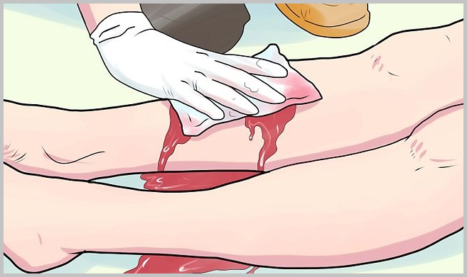 Как остановить кровотечение из варикозно расширенных вен