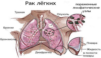 Особенности плоскоклеточного рака лёгких: формы, стадии, лечение и прогноз