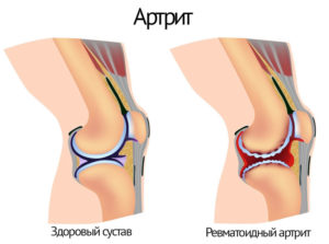 Почему болит и хрустит коленный сустав: к какому врачу обратиться и как лечить