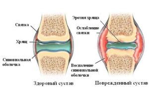 Резкая боль при разгибании коленного сустава: к какому врачу обратиться