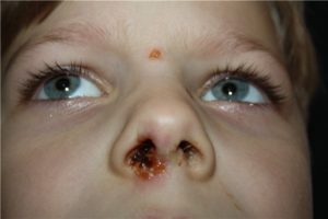 Герпес в носу у ребенка: симптомы, фото, лечение и профилактика