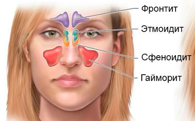 Показания для промывания носа Хлоргексидином при насморке и гайморите