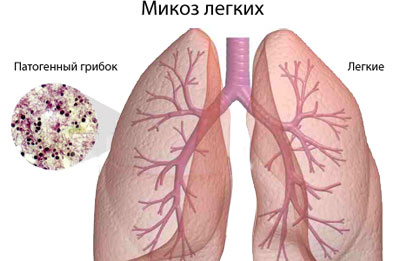 Классификация и причины интерстициальных заболеваний лёгких