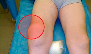 Лечение препателлярного бурсита коленного сустава