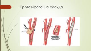 Внутренняя подвздошная артерия и ее ветви