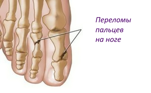 Первая помощь и лечение при переломе пальца на ноге