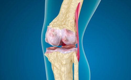 Лечение пателлофеморального артроза коленного сустава