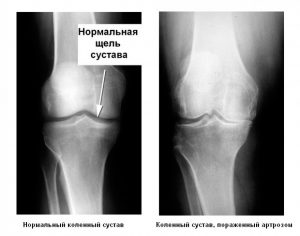 Стадии и лечение остеоартроза коленного сустава
