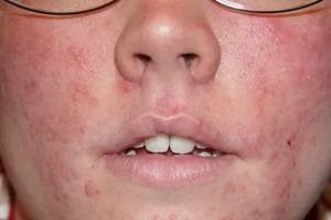 Покраснение в области носа: причины проявления симптома
