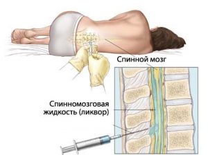 Как убрать боль в спине после эпидуральной анестезии?