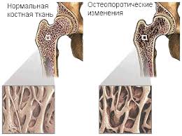 Опухоль бедренной кости: проведение прокола и характеристика пунктатов