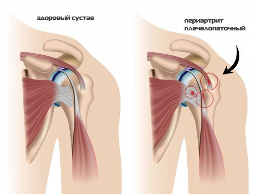 Методика Попова для лечения плечелопаточного периартрита