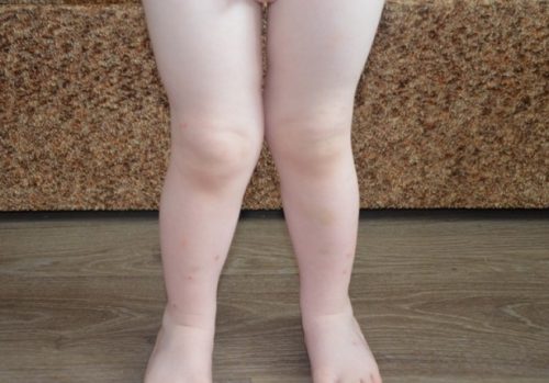 Лечение вальгусного искривления ног у ребенка