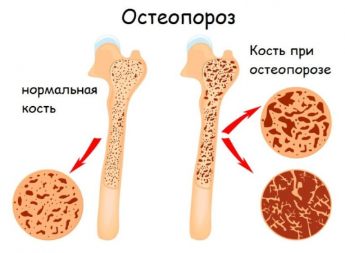 Что такое остеопороз и как его лечить?