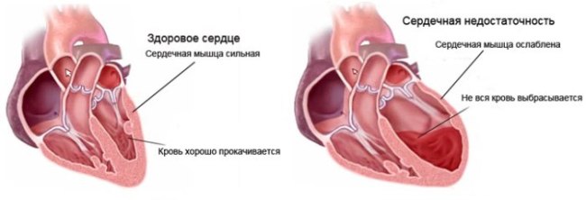 Что такое ишемическая болезнь сердца (ИБС)